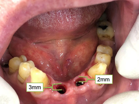 A picture of the mouth with places of installation of multi-uniting units on new implants