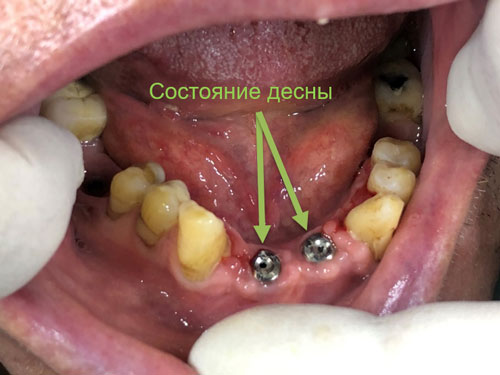 Image of the lower jaw showing the condition of the gums after osteointegration