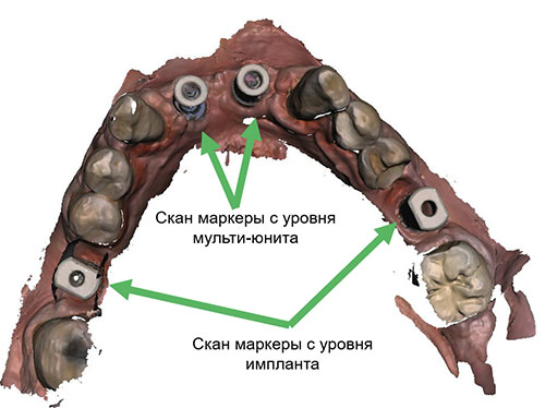 Scan of the lower jaw with scan markers