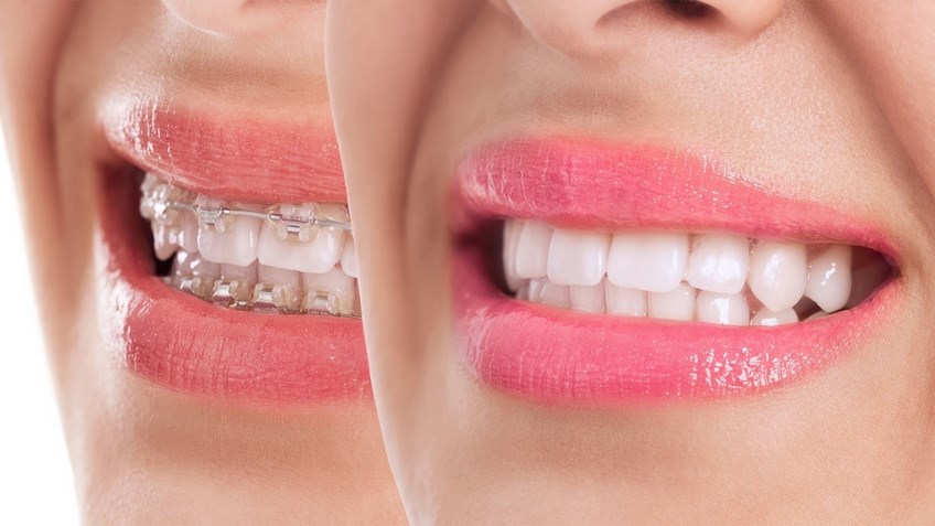 Эксперт в сфере стоматологии, рассказал «Известиям» о том, как правильно сделать выбор между брекетами и каппами, назвав их преимущества и недостатки.