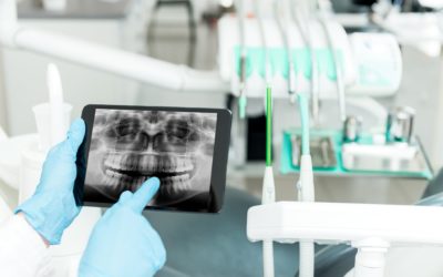 Мировой рынок зубных имплантатов: ускорение проникновения цифровой стоматологии для формирования сектора